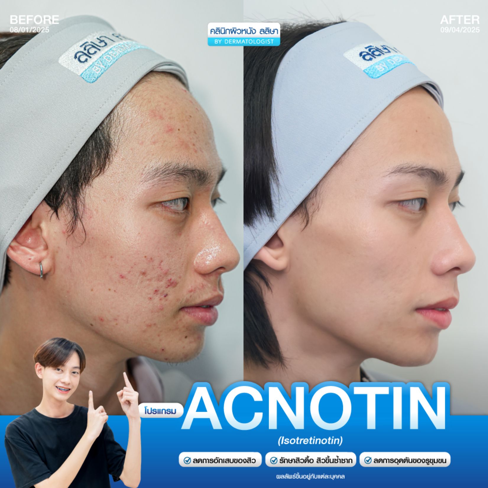 รีวิวโปรแกรม acnotin 2