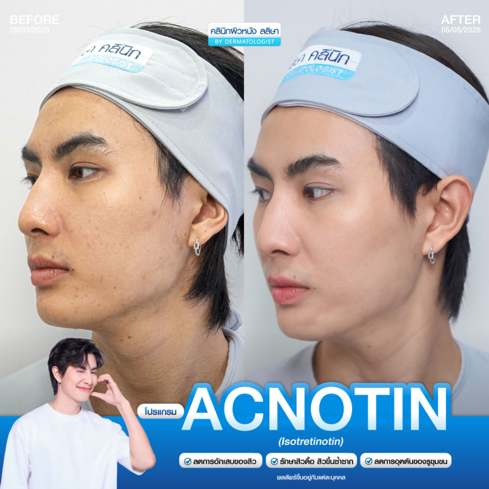 รีวิวโปรแกรม acnotin 3