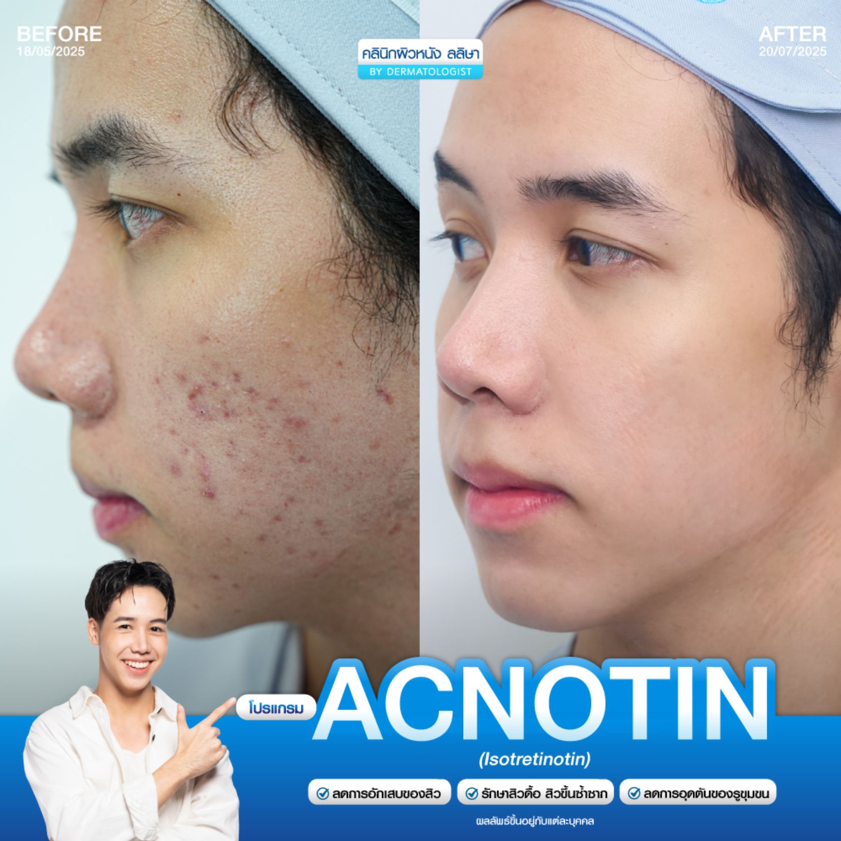 รีวิวโปรแกรม acnotin