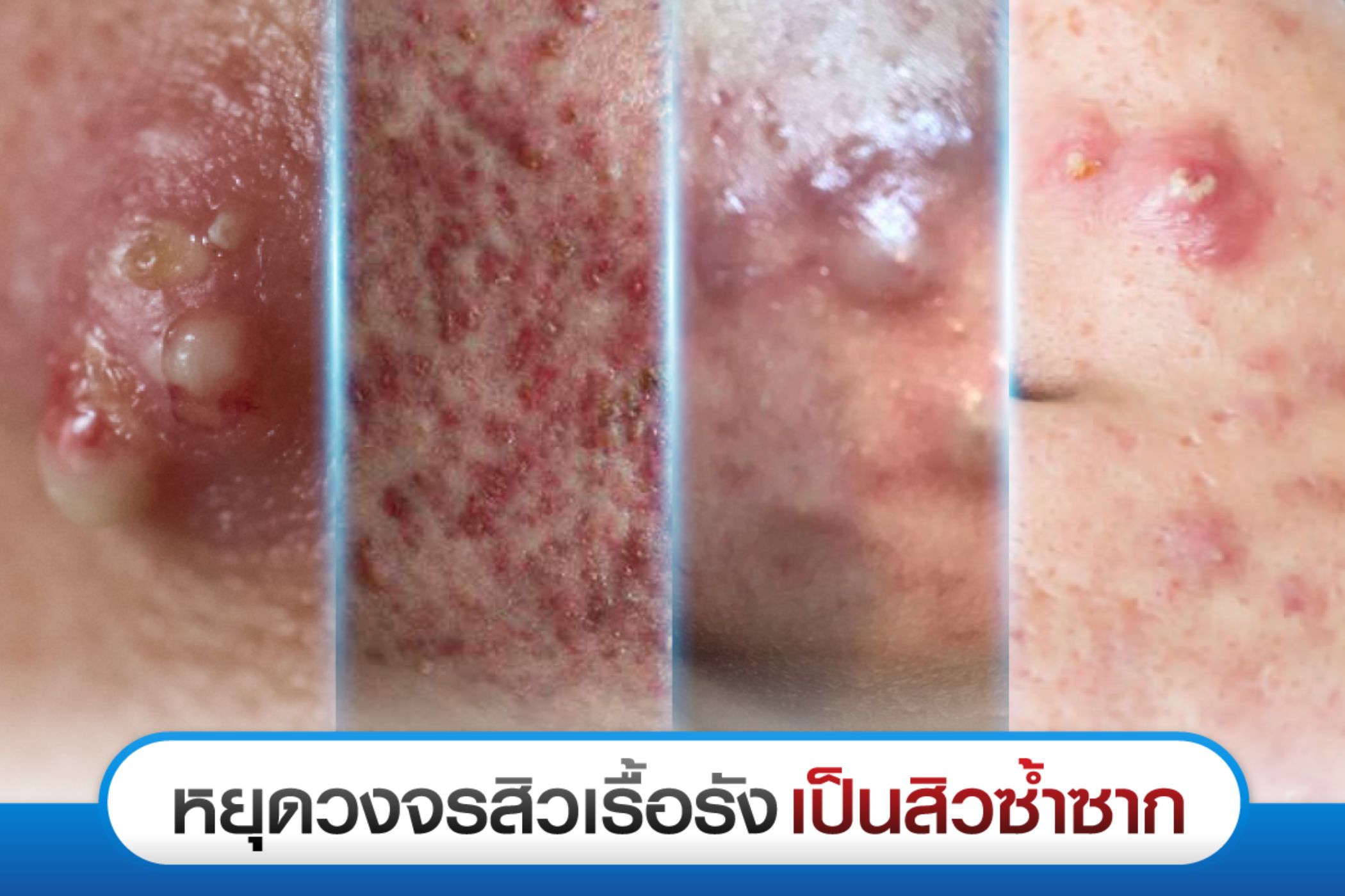 สิว