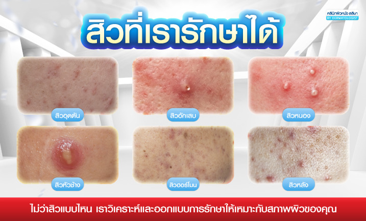 บริการรักษาสิวของเรา
