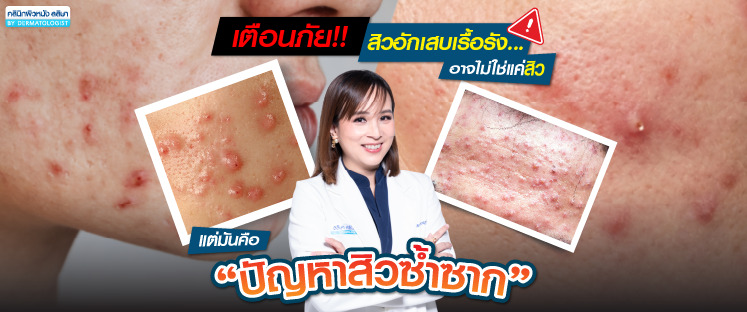 ปัญหาสิวซ้ำซาก รักษาอย่างไร