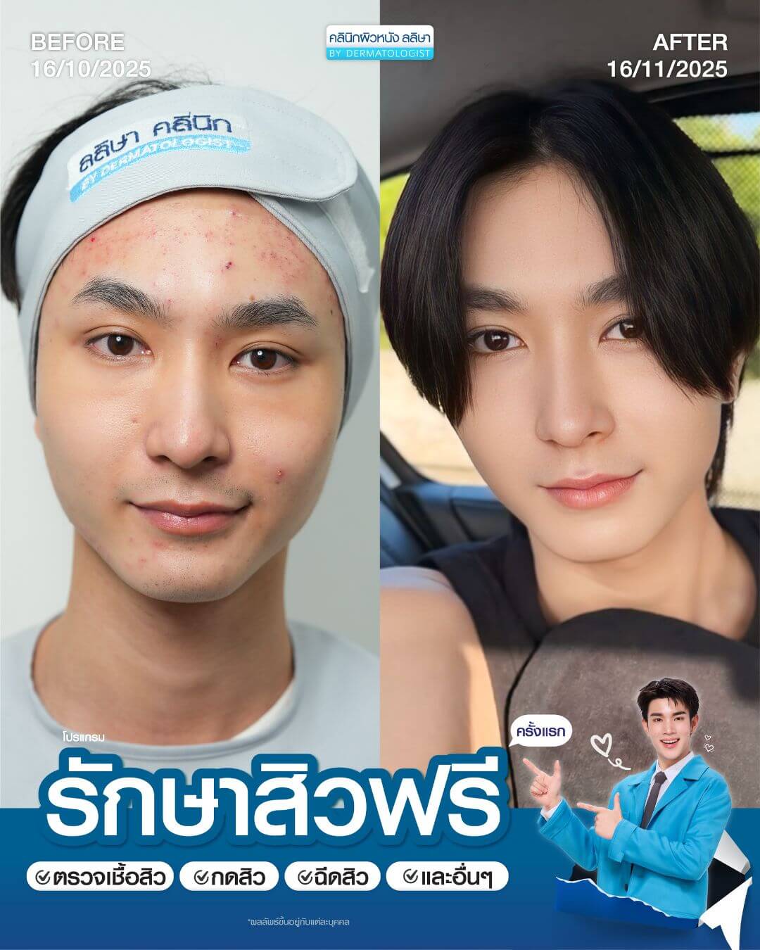 รีวิวผู้ชายรักษาสิว (02)