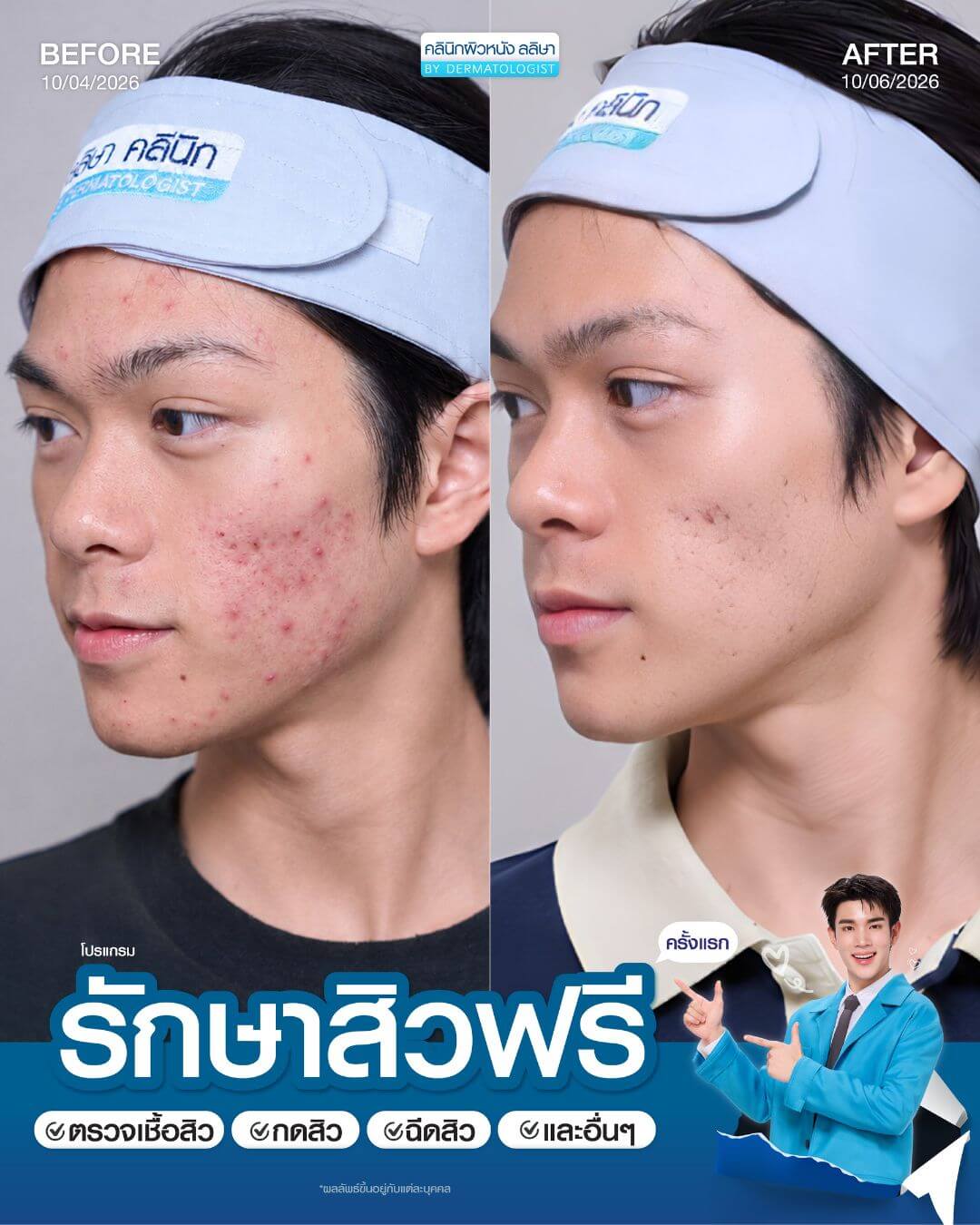 รีวิวผู้ชายรักษาสิว (03)