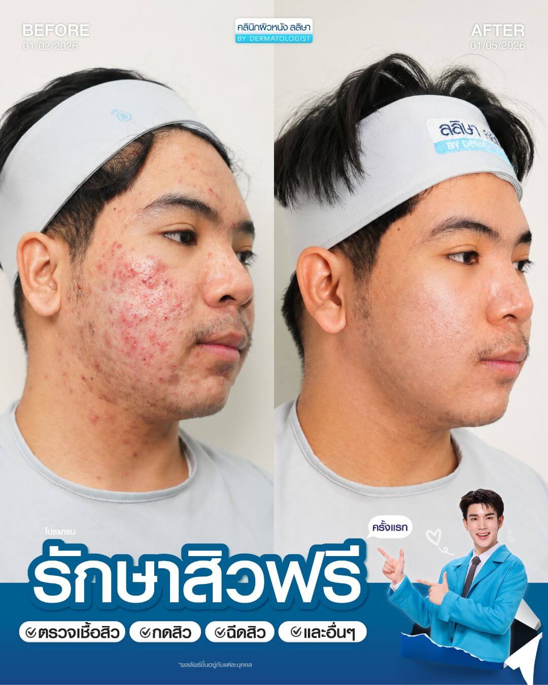 รีวิวผู้ชายรักษาสิว (04)