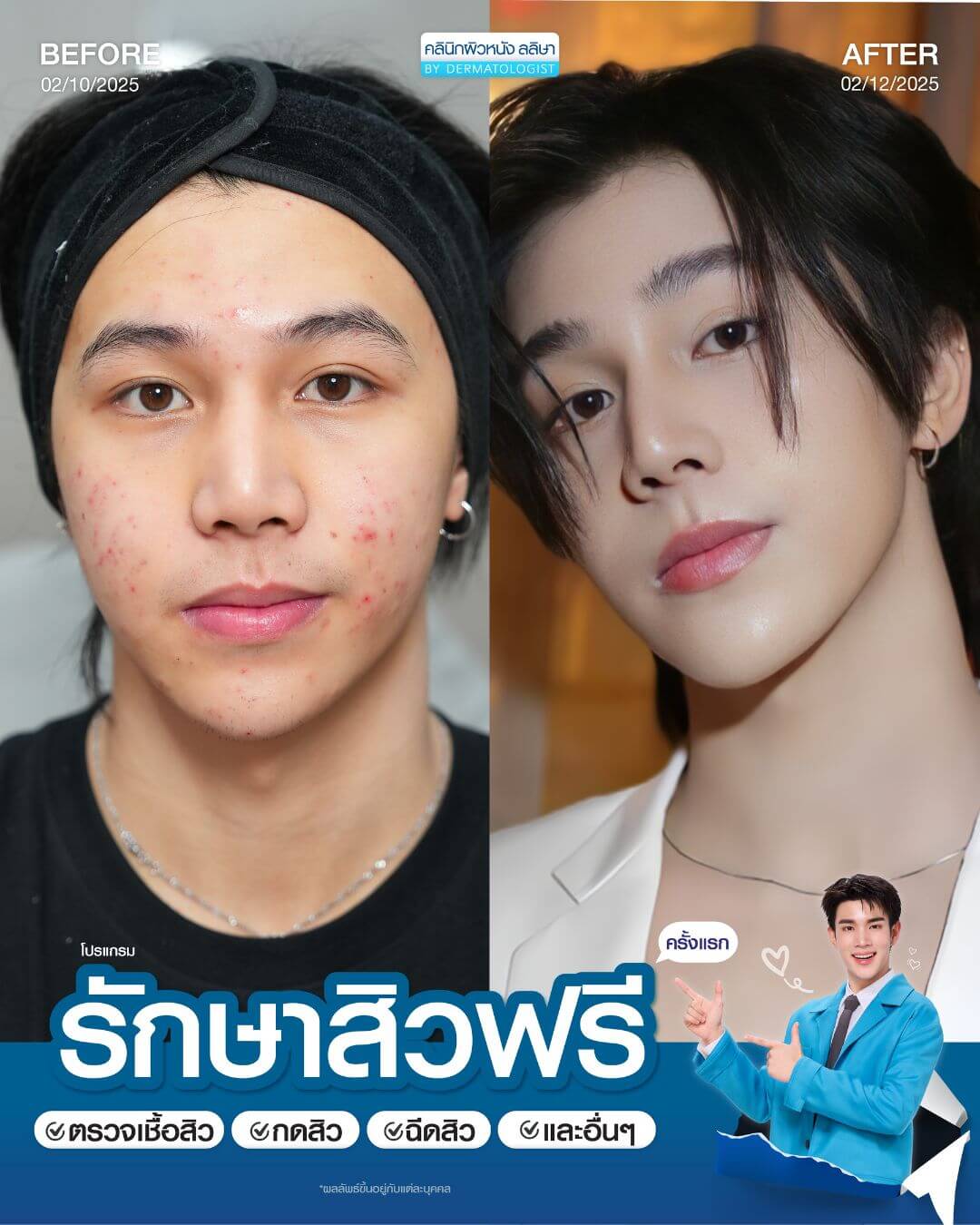 รีวิวผู้ชายรักษาสิว