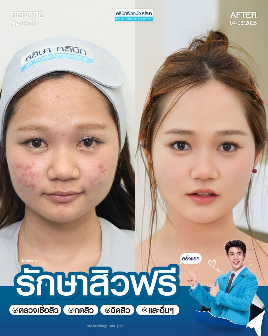 รีวิวผู้หญิงรักษาสิว (02)