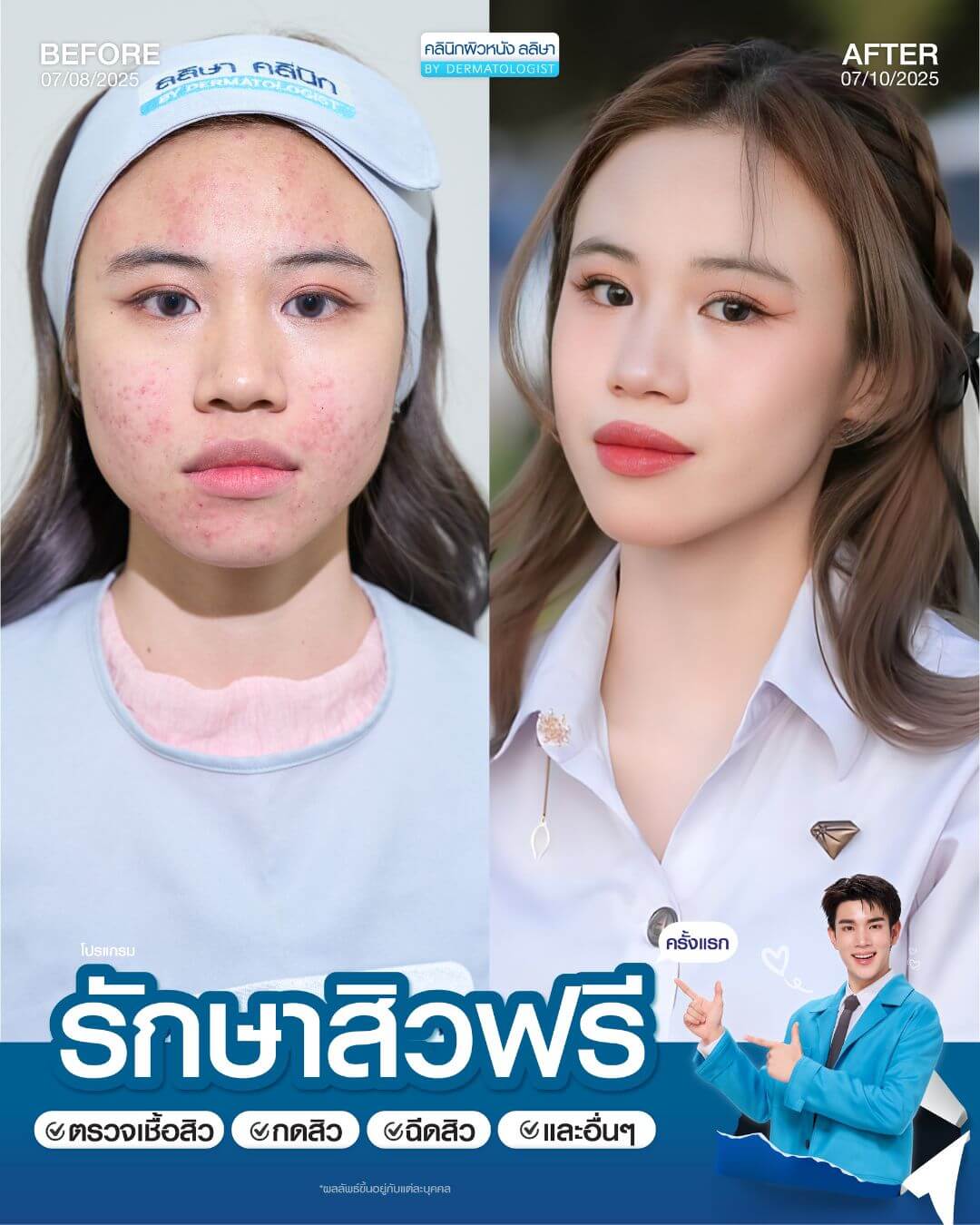 รีวิวผู้หญิงรักษาสิว (03)