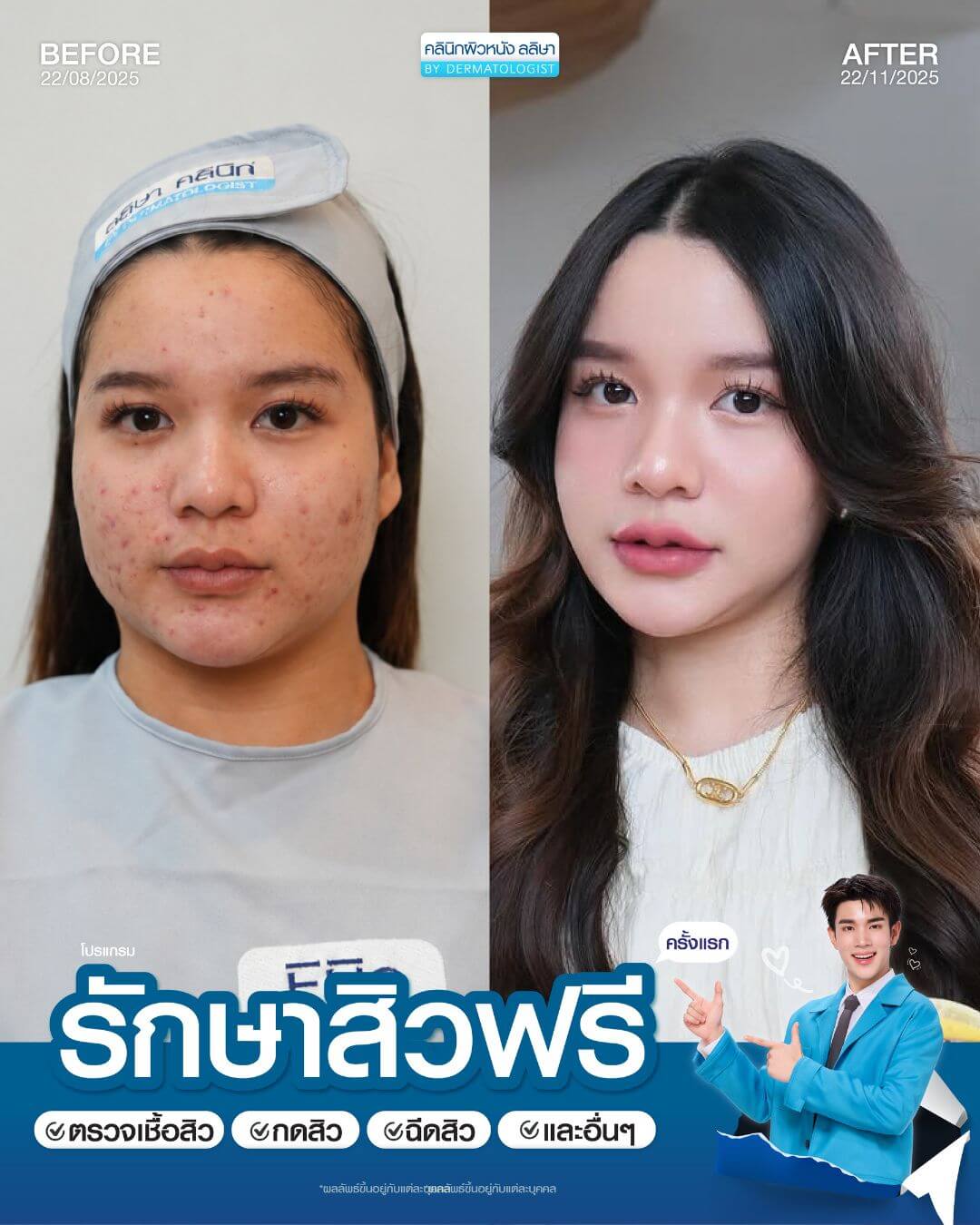 รีวิวผู้หญิงรักษาสิว (04)