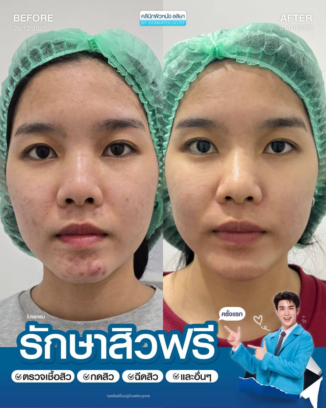 รีวิวผู้หญิงรักษาสิว (05)