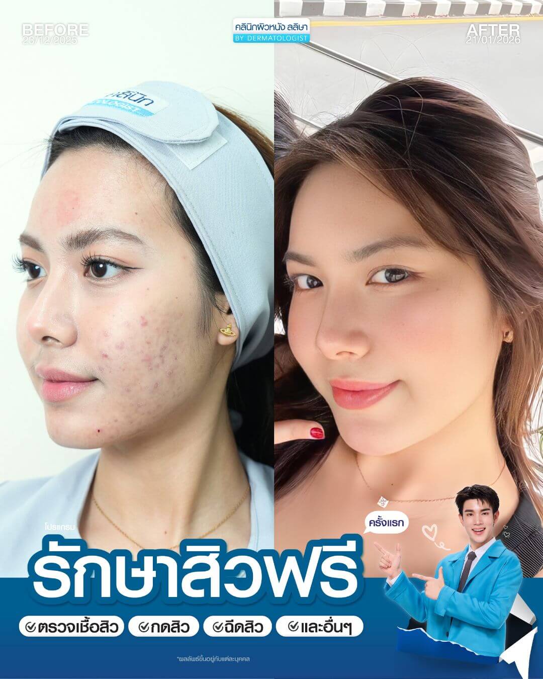 รีวิวผู้หญิงรักษาสิว