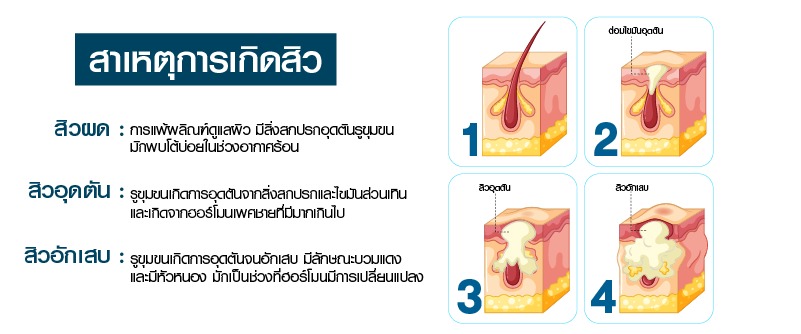 สาเหตุการเกิดสิว