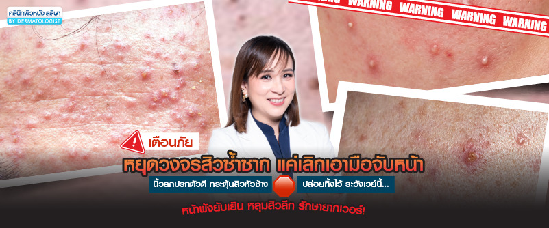 หยุดวงจรการเกิดสิว